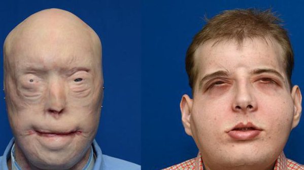 pozharnomu-peresadili-litso-pogibshego-velosipedista-foto-abcnetau_rect_9dbc3619502073e5319c438c7690390b.jpg (37.24 KiB) Просмотров: 4979 pozharnomu-peresadili-litso-pogibshego-velosipedista-foto-abcnetau_rect_9dbc3619502073e5319c438c7690390b.jpg